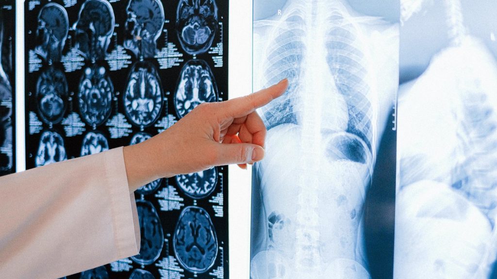 doctor pointing at x-ray of spine